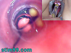 Mature Woman, Peehole Endoscope Camera in Bladder with Ball Sack