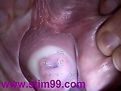 Insertion Gravy in Cervix Pussy Speculum. Cum in Uterus