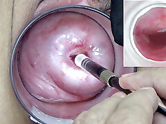 A endoscope japanese camera is inserted in the cervix to witness inwards the uterus.