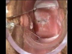 Spéculum De Sperme Spéculum De Sperme