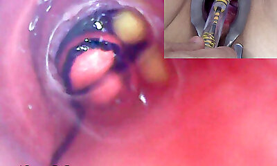 Mature Woman, Peehole Endoscope Camera in Bladder with Sack
