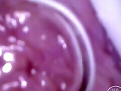 POV Endoscope Catheter Bladder Inflation!