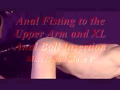 Anal Fisting to the Upper Arm and XL Anal Ball Insertion