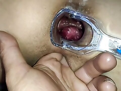एक गुदा लिंग विकसित किया और एक चिकित्सा दर्पण के साथ गुदा की एक परीक्षा के साथ एक लिंग मिला